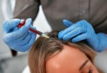 حقن الأكسوزوم لعلاج الصلع وتحفيز نمو الشعر Exosome injections to treat baldness and stimulate hair growth